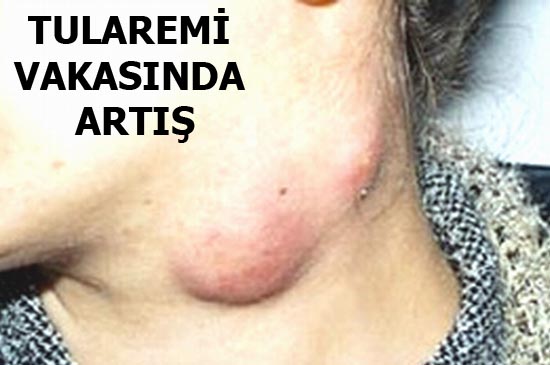 İlçemizde bu hastalıktan çok görünüyor